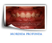 sobremordida profunda